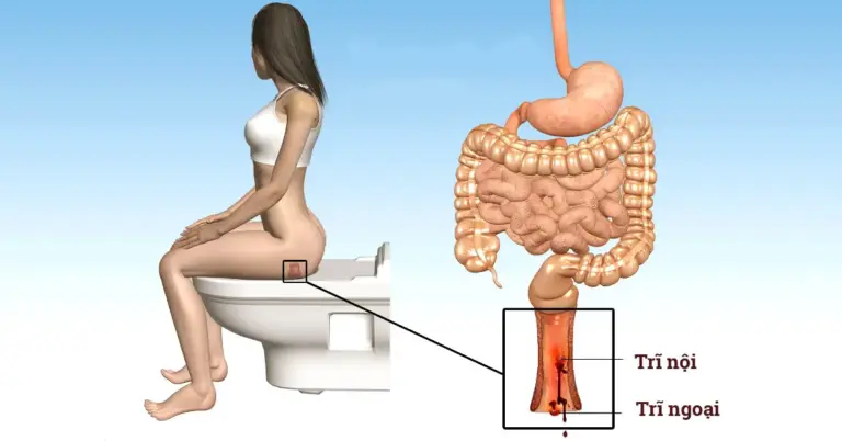 Tìm Hiểu Về Bệnh Trĩ Và TOP 5 Phòng Khám Trĩ Huế Tận Tâm