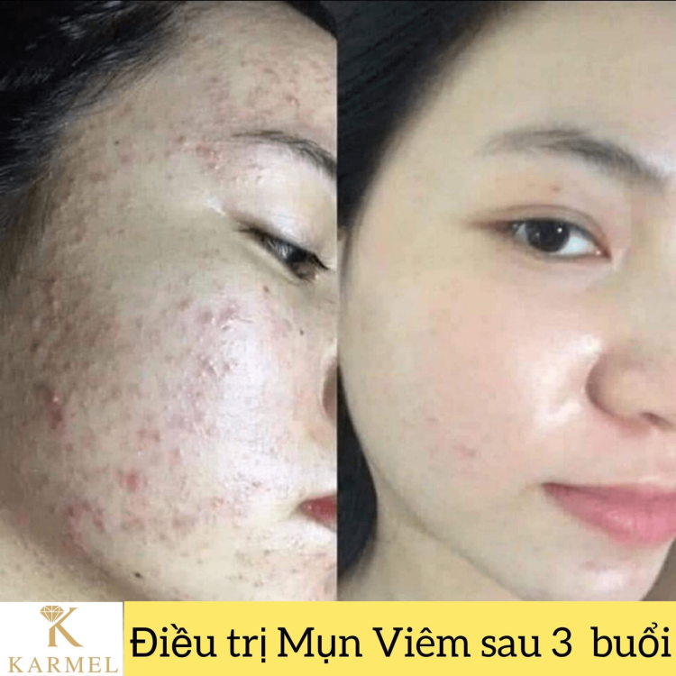 spa trị mụn Quảng Ngãi