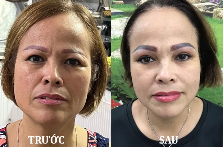 Tiêm Filler Botox Hải Phòng