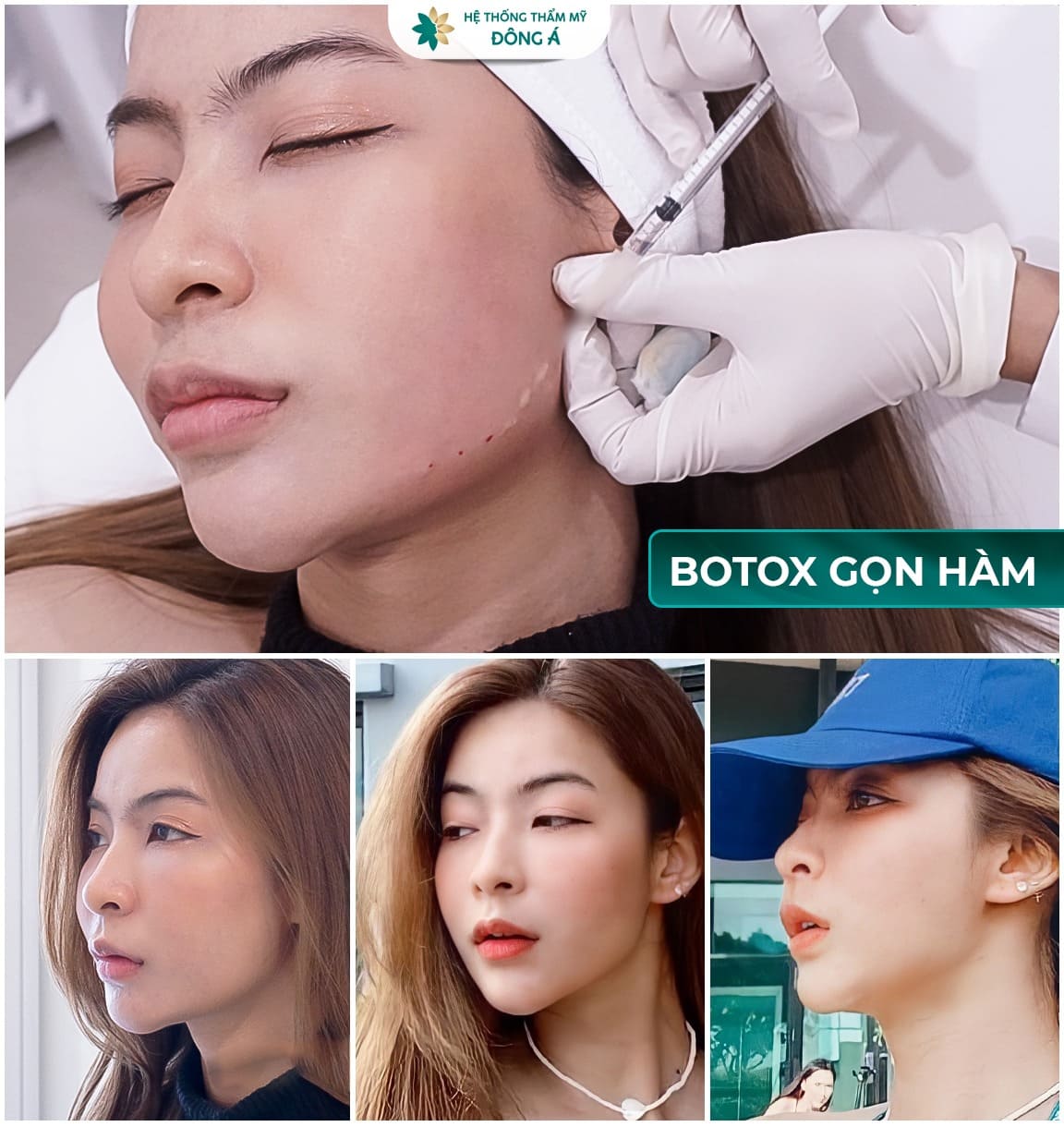 tiêm botox Đà Nẵng