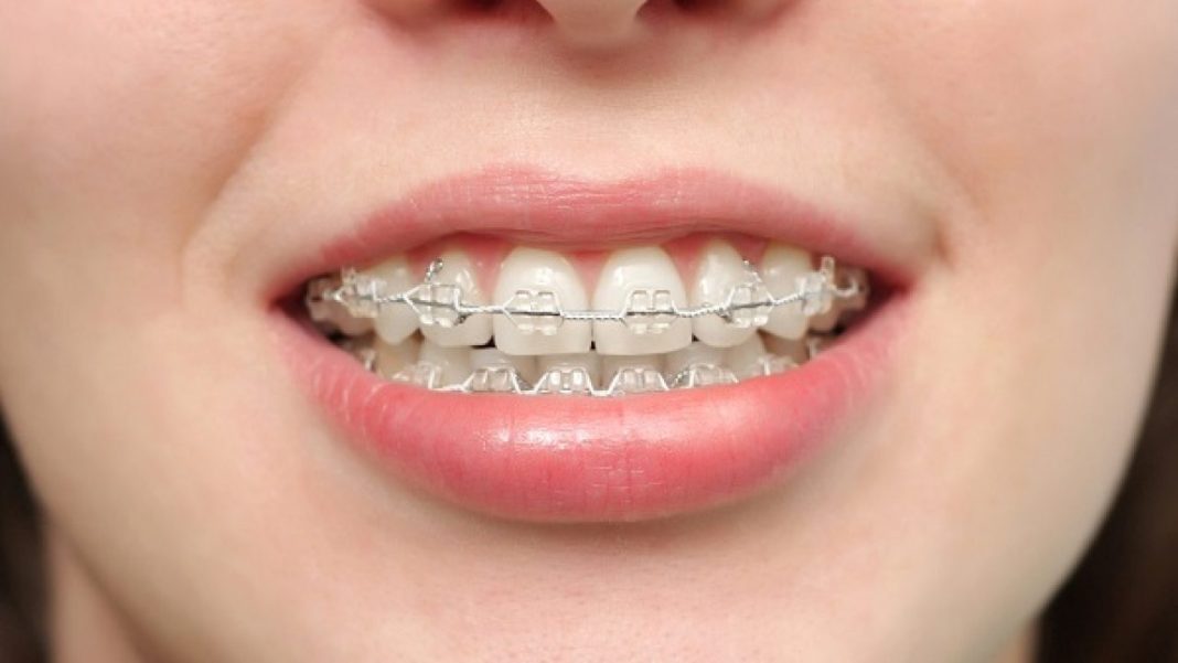 Niềng Răng BMT Niềng Răng BMT