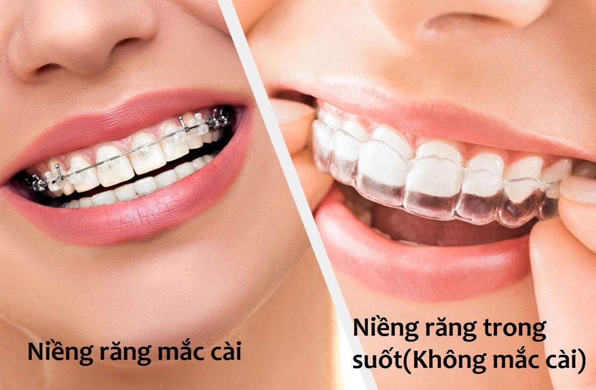 Niềng Răng BMT