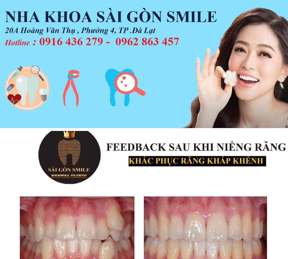 niềng răng Đà Lạt Nha khoa Sài Gòn Smile
