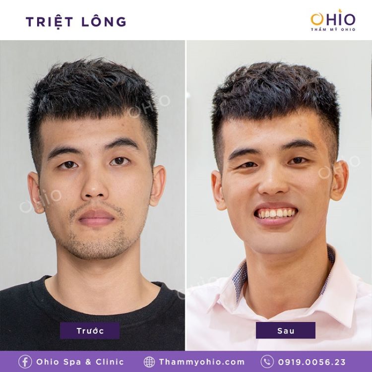 triệt lông cho nam giới ở TPHCM