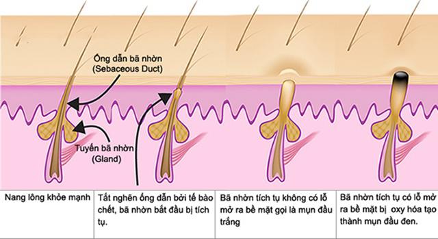 cách xử lý mụn đầu đen