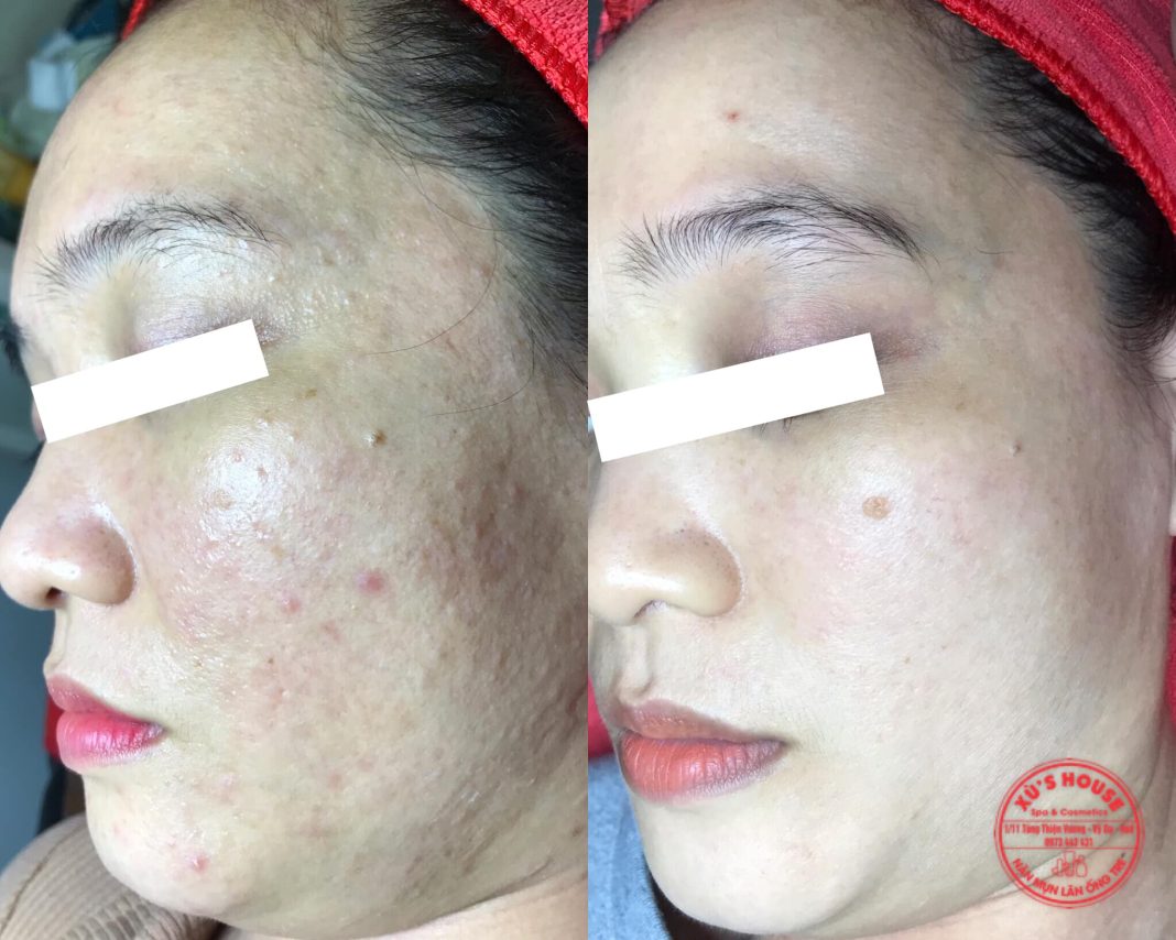 spa trị mụn ở Huế spa trị mụn ở Huế