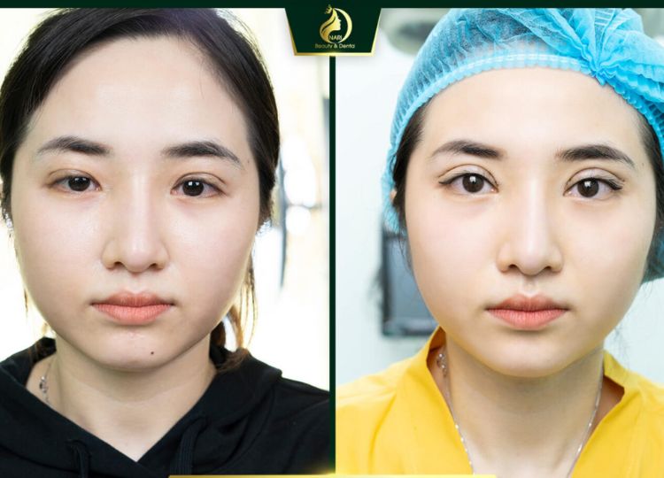 cắt mí Cần Thơ cắt mí Cần Thơ