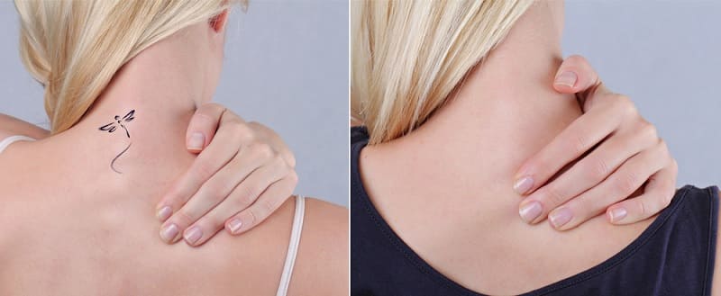 dia-chi-xoa-xam-da-nang-1 địa chỉ xóa xăm đà nẵng