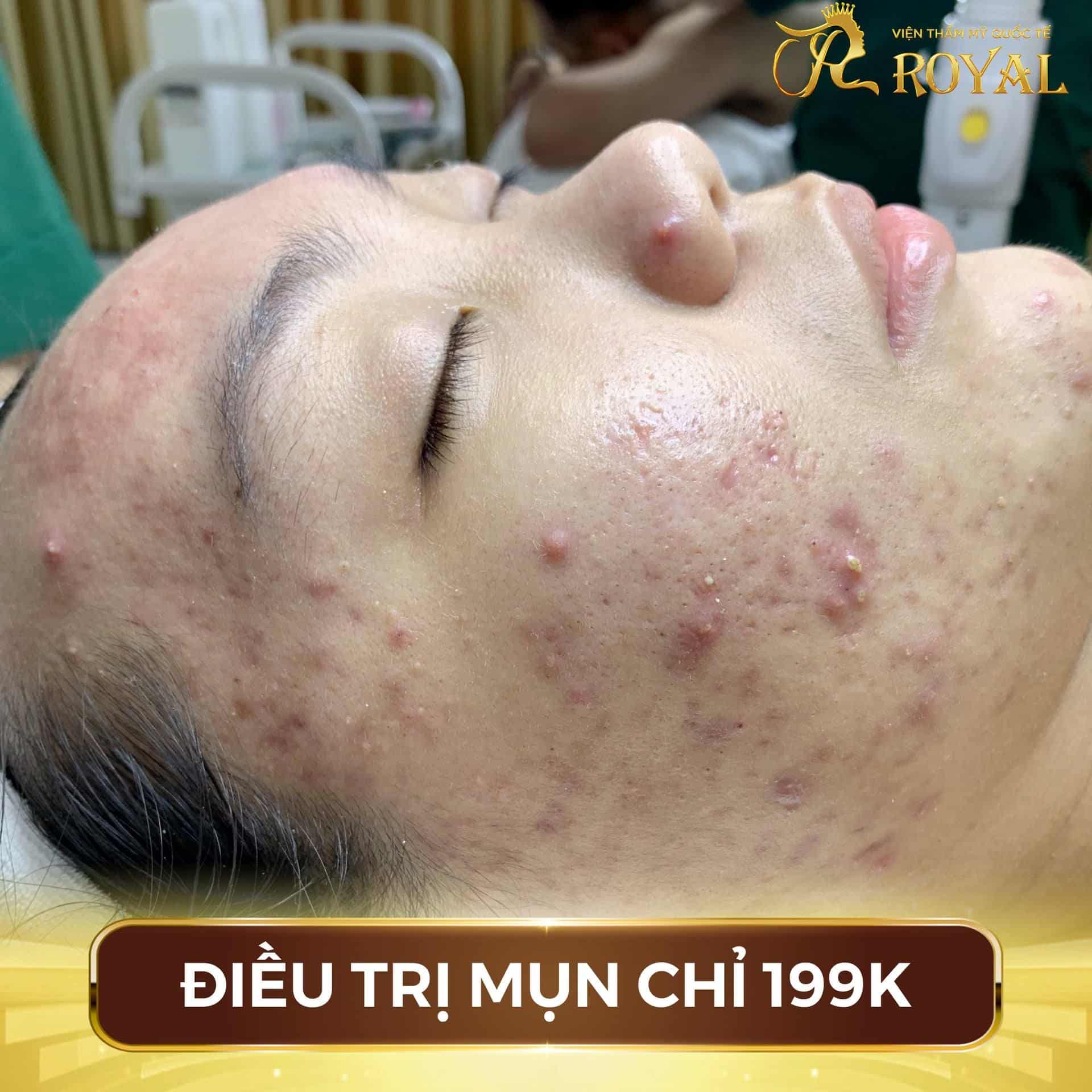 trị mụn lượng