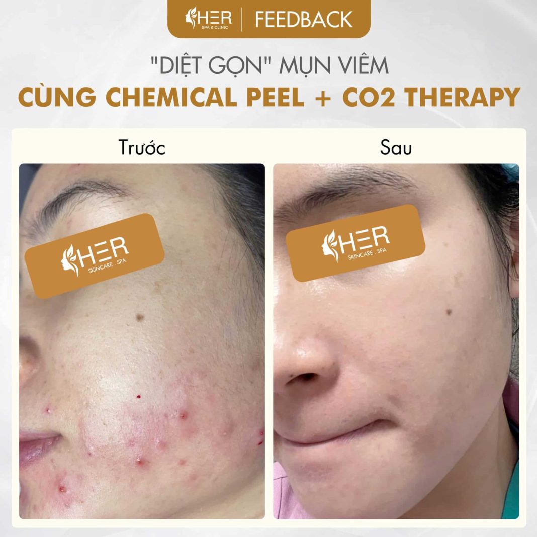 spa trị mụn Hải Phòng spa uy tín