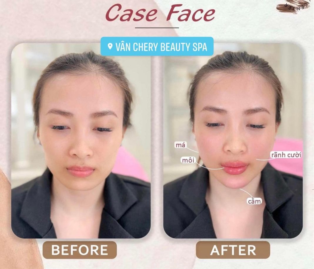 tiêm filler nha trang tiêm filler nha trang