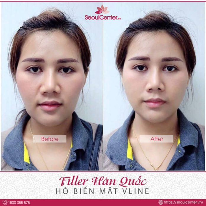 tiêm filler uy tín hà nội