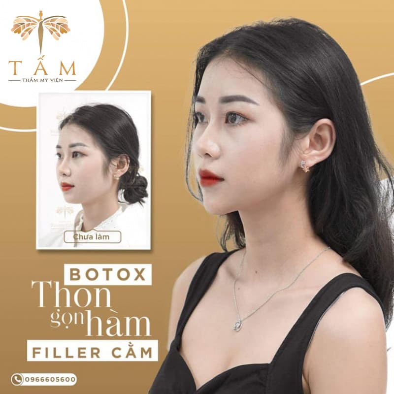 tiêm filler hà nội