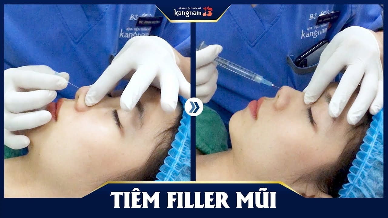 tiêm filler uy tín hà nội