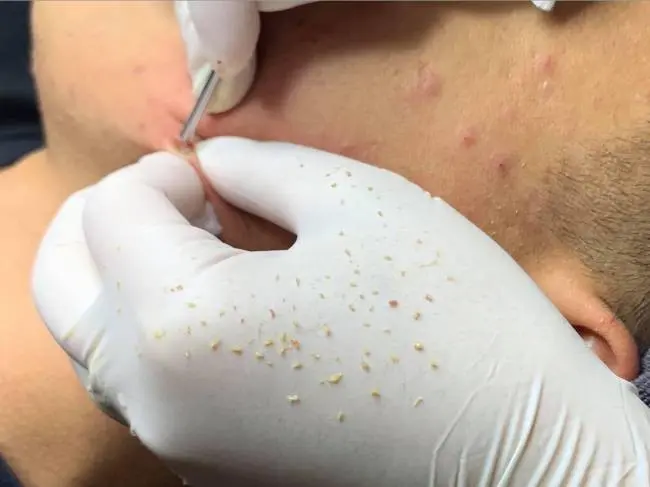 Tuổi dậy thì có nên đi spa nặn mụn không? Những lý do nên đi spa