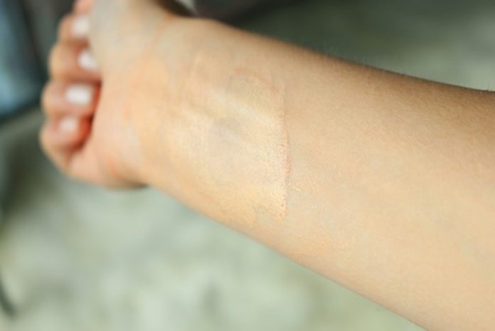 Có nên đi xăm màu da che sẹo không? Các lưu ý khi đi xăm