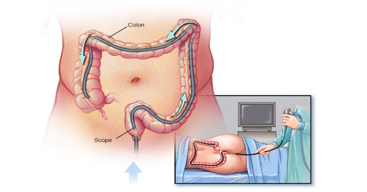 Các loại nội soi phổ biến: Nội soi dạ dày, đại tràng, tai mũi họng Nội soi đại tràng