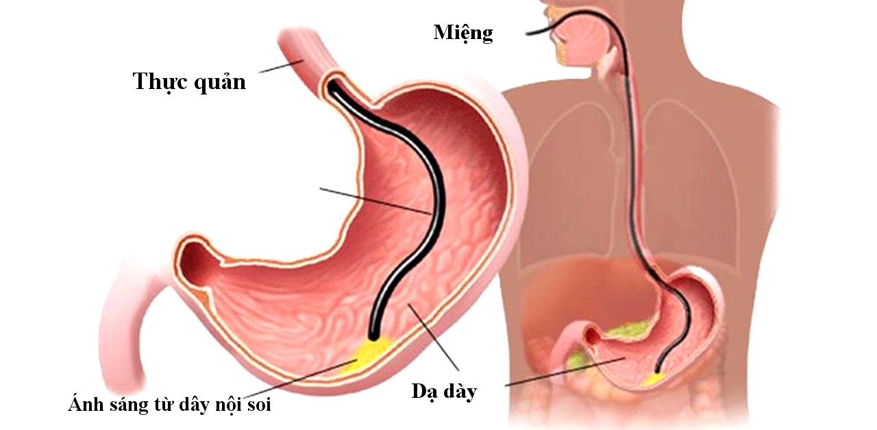 quy trình nội soi có đau không cần chuẩn bị gì Nội soi dạ dày/đại tràng có gây mê
