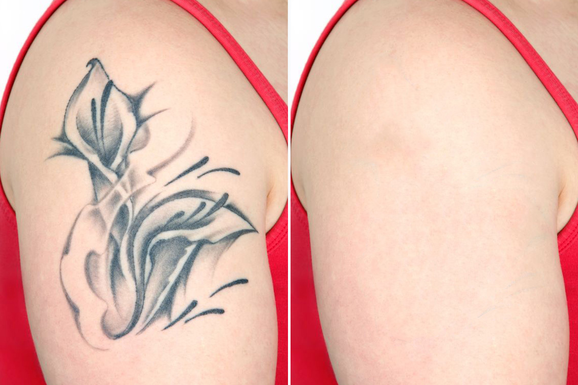 Xoá xăm Đà Nẵng - Tiệm Tuấn Tattoo