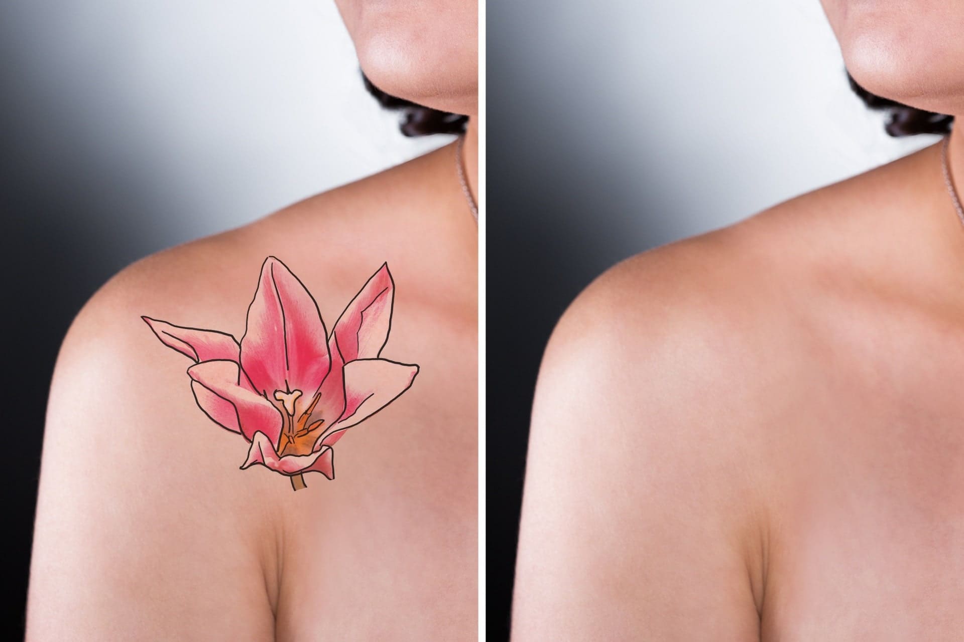 Xoá xăm Đà Nẵng - bác sĩ Nhân
