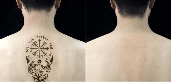 Xoá xăm Đà Nẵng - Thẩm mỹ Viện Văn Trường